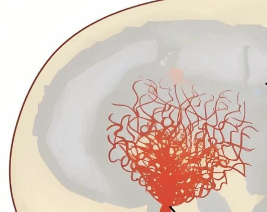 脑外科检查结果揭示—你可能未曾听说的烟雾病！