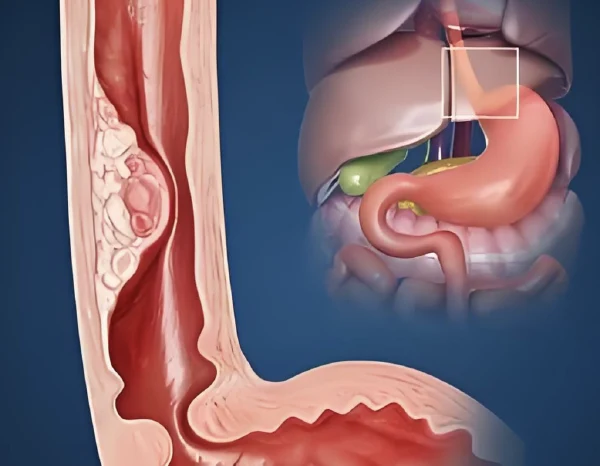 了解食管癌：分类、诊断、分期与综合治疗