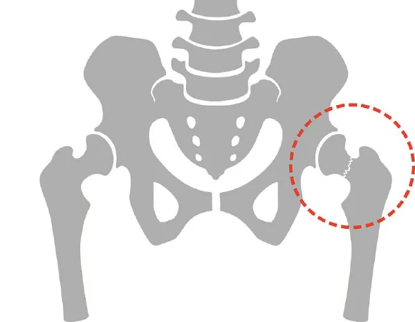 股骨颈骨折：破损的髋部与心如刀绞的抗争!