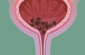 膀胱结石:什么是膀胱结石?你需要了解的一切!