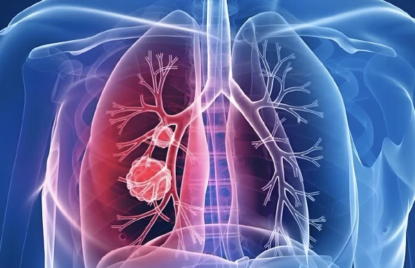 右肺恶性肿瘤的全面解析与管理指南