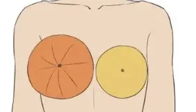 早期发现,及时治疗——乳腺癌防治刻不容缓!