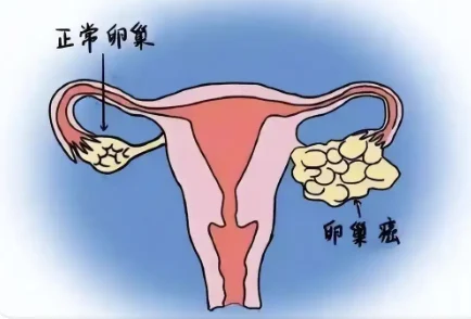 直击女性健康:关注卵巢癌及其防治方法