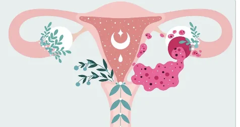 女性朋友们注意了！了解卵巢囊肿的真相及预防