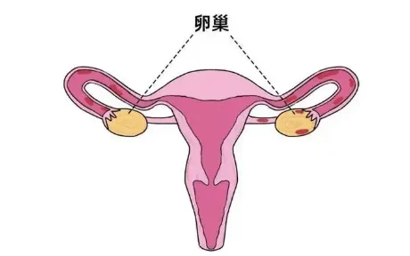 全面了解卵巢癌：预防、诊断与治疗新进展