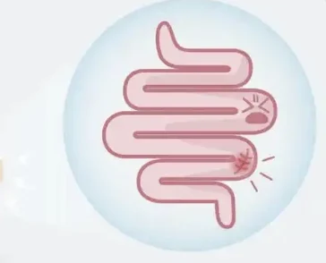 关注肠道健康—了解肠梗阻与乙状结肠癌引发的严重后果!