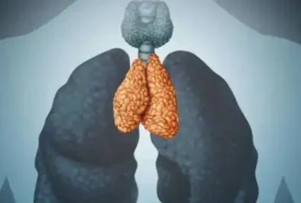 胸腺瘤：深入探讨及科学治疗！