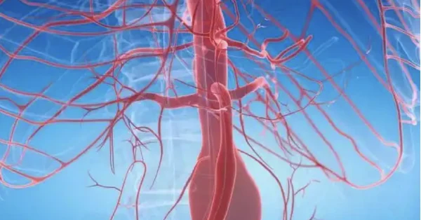 腹主动脉瘤:悄无声息的腹部“炸弹”