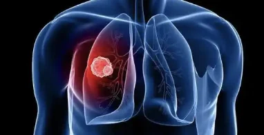 全面解析肺恶性肿瘤的诊断与治疗
