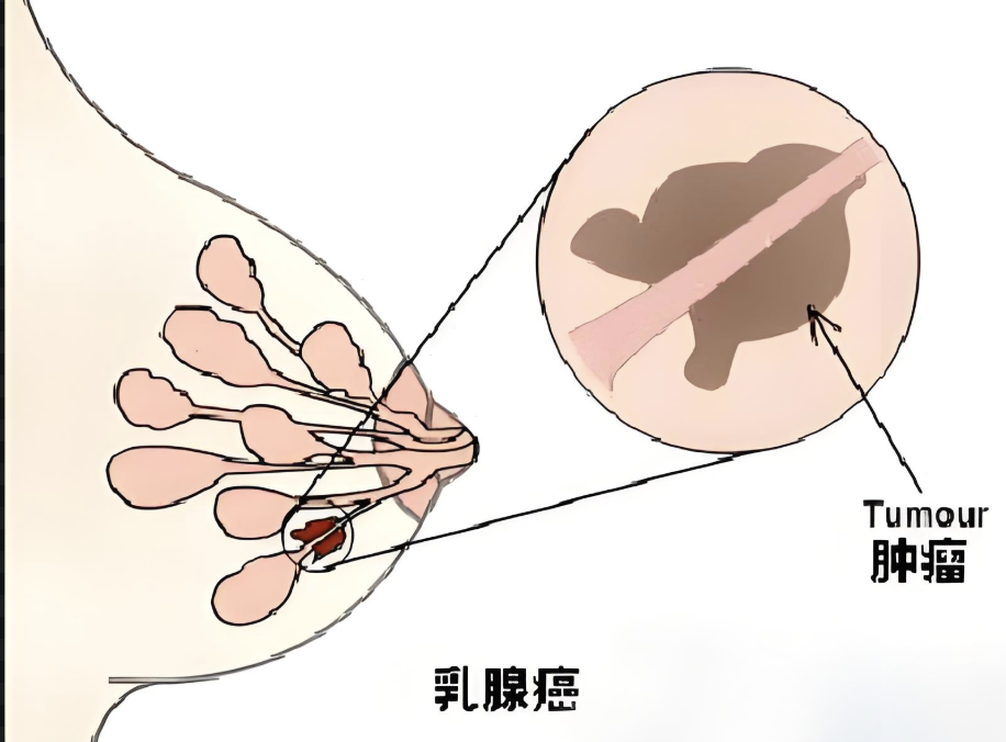 科普，深入了解乳腺癌：全面诊断与治疗指南封面图