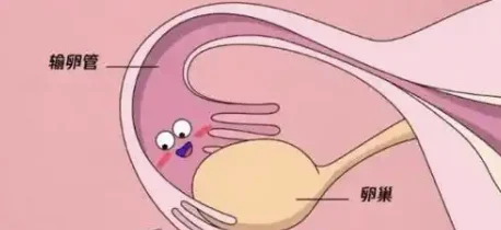 下腹痛让你束手无策?——揭开输卵管系膜囊肿的谜团!