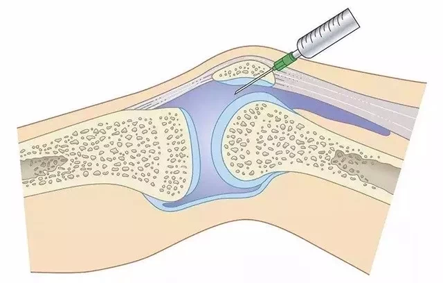 膝关节药物治疗揭秘——全方位了解药物作用机制及应用！