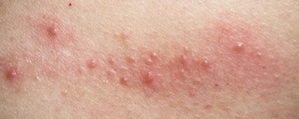 湿疹:识别、诊断与治疗全攻略