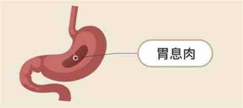 科普，胃息肉与慢性胃炎：你需要知道的那些事儿封面图