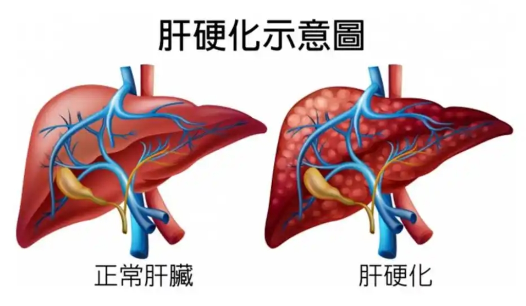 肝硬化失代偿期：全面解析及科学管理