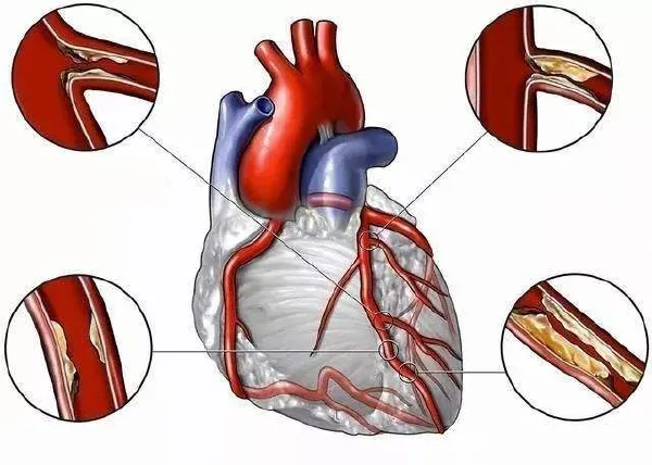 如何全面了解缺血性心肌病:诊断与管理的关键指南