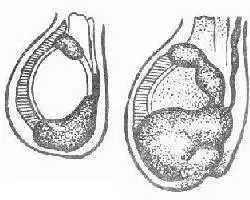 了解睾丸鞘膜积液:从症状到治疗全方位解析