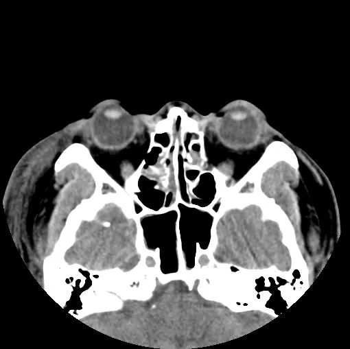 鼻骨骨折：认识、治疗和预防，一篇你不能错过的医学小科普！