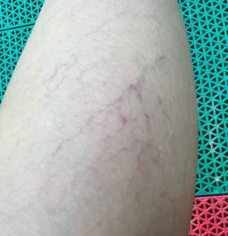 了解下肢静脉曲张：类型、诊断、治疗及管理