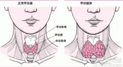 探索甲状腺肿物：病因、诊断、治疗及日常管理全解析