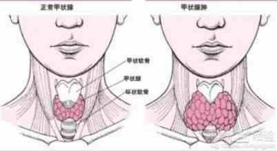 科普，探索甲状腺肿物：病因、诊断、治疗及日常管理全解析封面图