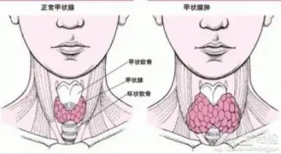 探索甲状腺肿物：病因、诊断、治疗及日常管理全解析