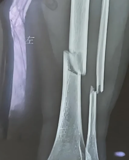 骨折怎么办?全方位解读及预防指南,骨科专家为您详细讲解!