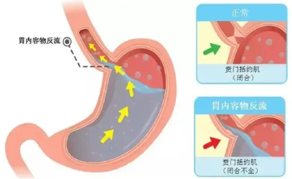 反流性食管炎与癌症关联:综合诊疗与管理