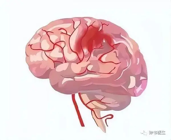 理解脑出血和高血压：从诊断到管理