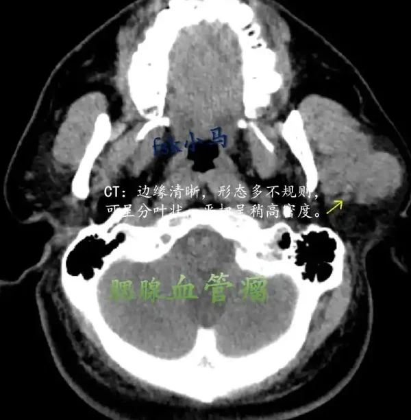 腮腺瘤需要重视!—深入解析与预防篇