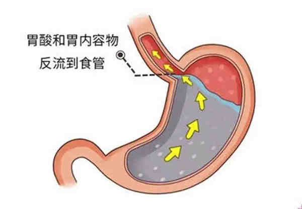 反流性食管<span style="color: #da4707">炎</span>的全面解析：从诊断到治疗及<span style="color: #da4707">生活</span><span style="color: #da4707">调整</span>