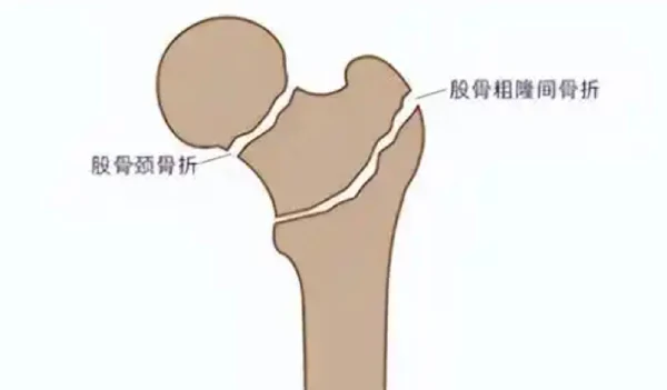 股骨粗隆间骨折的综合管理与治疗策略