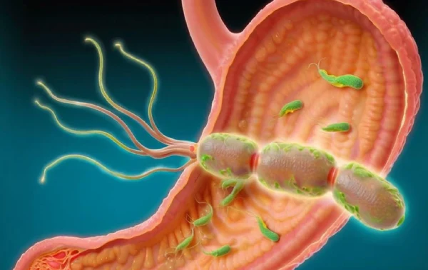 幽门螺旋杆菌感染：诊断与治疗全解析