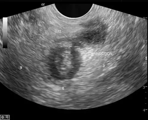 肛周脓肿——隐藏在痛苦背后的隐患!