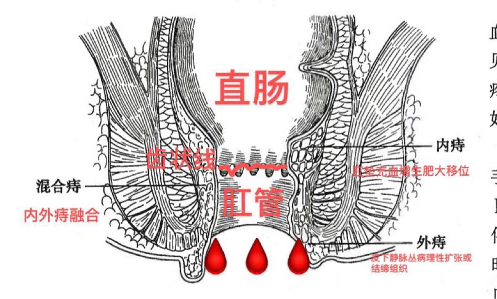 混合痔与肛乳头肥大——不可小觑的健康敌人！