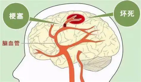 脑健康守护者——浅析脑梗塞与多药协同治疗！