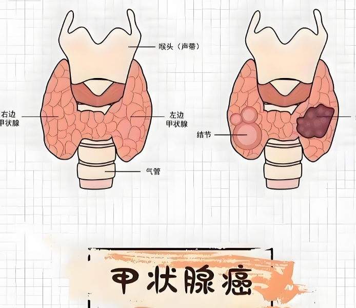 全面解析甲状腺肿瘤：从诊断到治疗