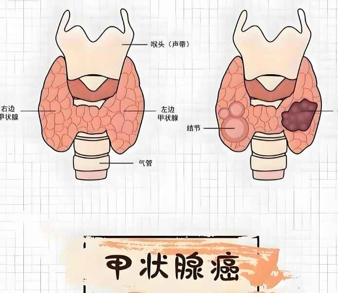 科普，全面解析<span style="color: #da4707">甲状腺</span><span style="color: #da4707">肿瘤</span>：从诊断到<span style="color: #da4707">治疗</span>