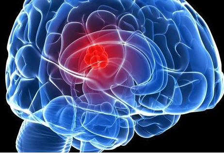 头痛、头晕、恶心？警惕脑部肿瘤——胶质母细胞瘤