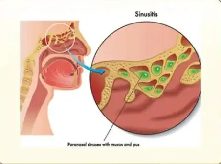 变应性鼻炎与慢性鼻窦炎的识别与预防