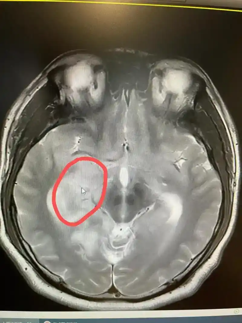 警惕脑部肿瘤！了解脑膜瘤及其预防措施