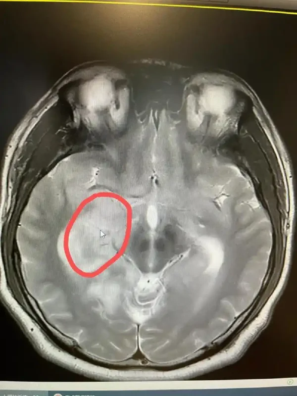 警惕脑部肿瘤!了解脑膜瘤及其预防措施