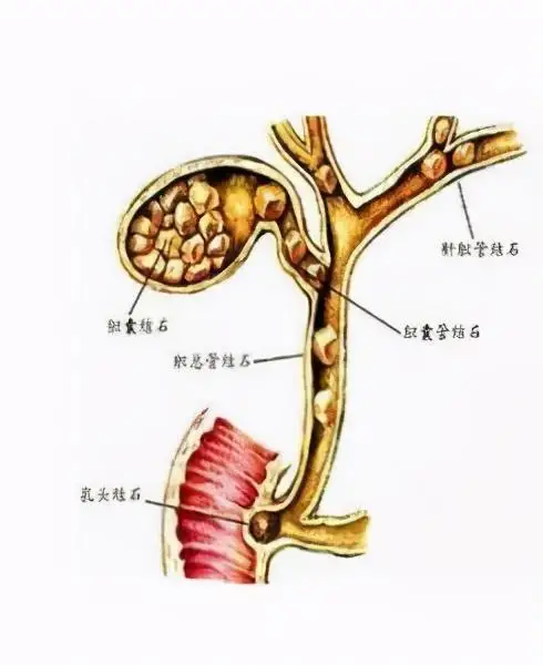 胆管结石——你不知道的健康隐患!