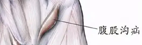 注意了!右侧腹股沟区斜疝:你所不知道的常见病