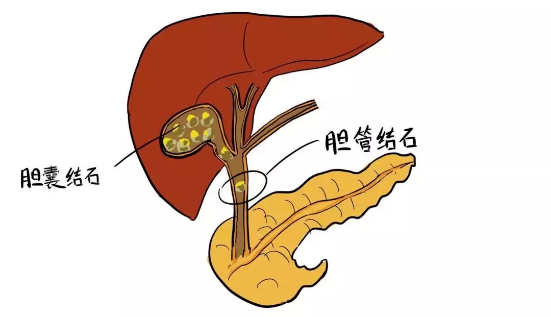 胆囊结石不是小事——早预防早治疗，摆脱隐痛折磨！