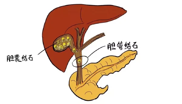 胆囊结石患者围术期麻醉管理:如何平衡风险与安全?