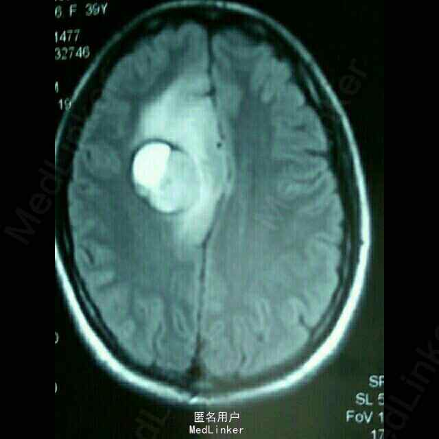 右侧额叶及脑旁室占位性病变的综合诊疗管理