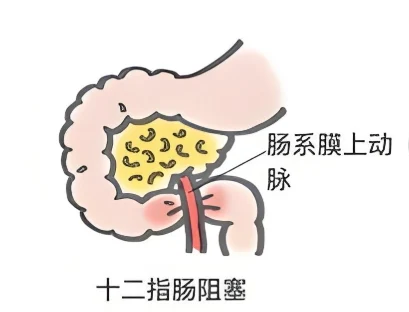 了解肠梗阻:62岁患者的健康警钟
