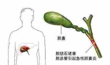 如何远离胆囊结石和胆囊炎，这里有你想知道的！封面图