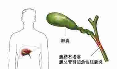 科普，如何远离胆囊结石和胆囊炎，这里有你想知道的！封面图